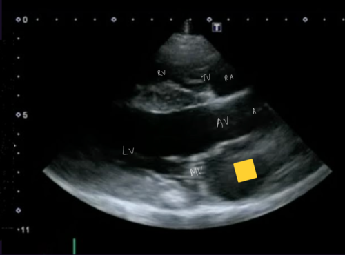 <p>Right parasternal 5 chamber view</p>