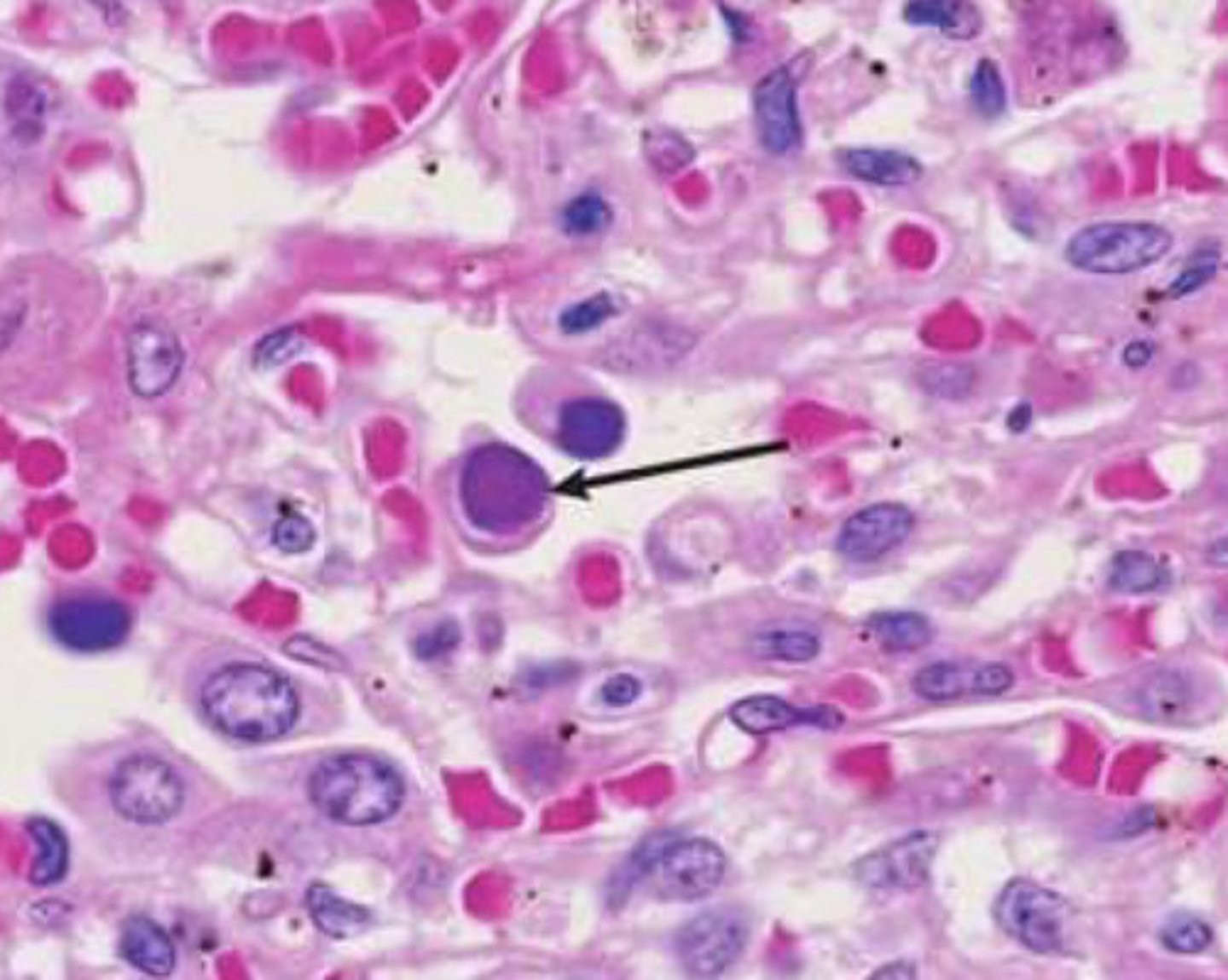 <p>you can make a definitive diagnosis of CAV2 via viral isolation from bronchial epithelium...what will you see?</p>