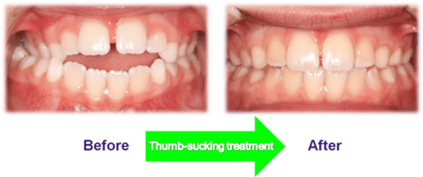 <p>A picture of a kid showing an open bite, this can be caused by</p>