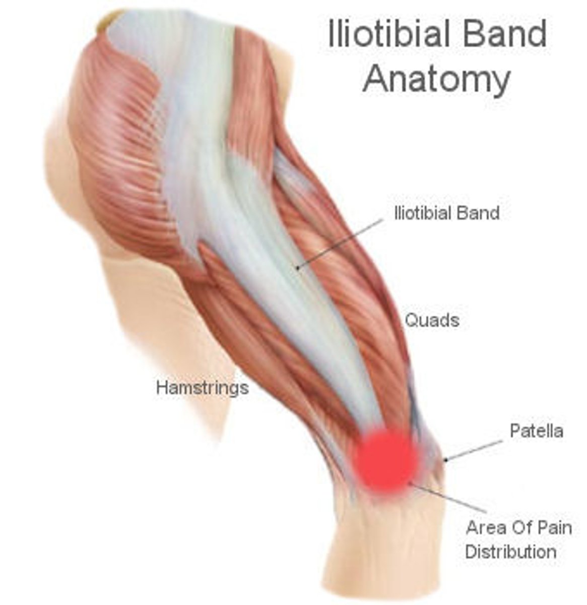 <p>occurs when the iliotibial band becomes irritated and rubs on the lateral femoral epicondyle</p><p>- results from repetitive flexion/extension</p>