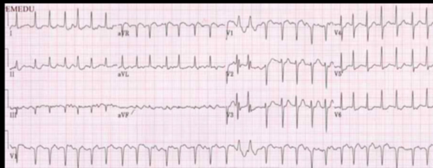 <p>IRREGULAR</p><p>Ventricular rate: 100-175</p><p>P wave: unable to see</p><p>PR Interval: N/A</p><p>QRS &lt;0.12 sec</p>