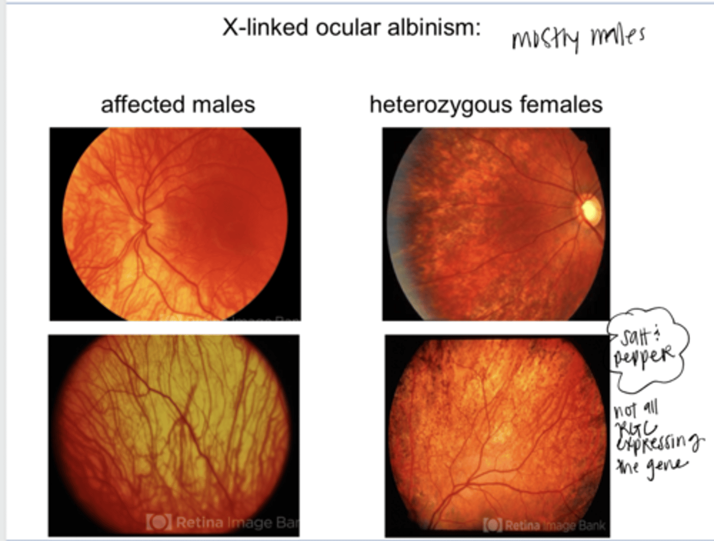 <p>X Linked Ocular Albinism in Males/Female Carriers (Pic)</p>