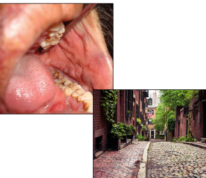 <ul><li><p>diffuse, nodular swelling </p></li><li><p>cobblestone appearance of oral mucosa </p></li><li><p>linear ulcerations of the buccal vestibule </p></li></ul><p></p>