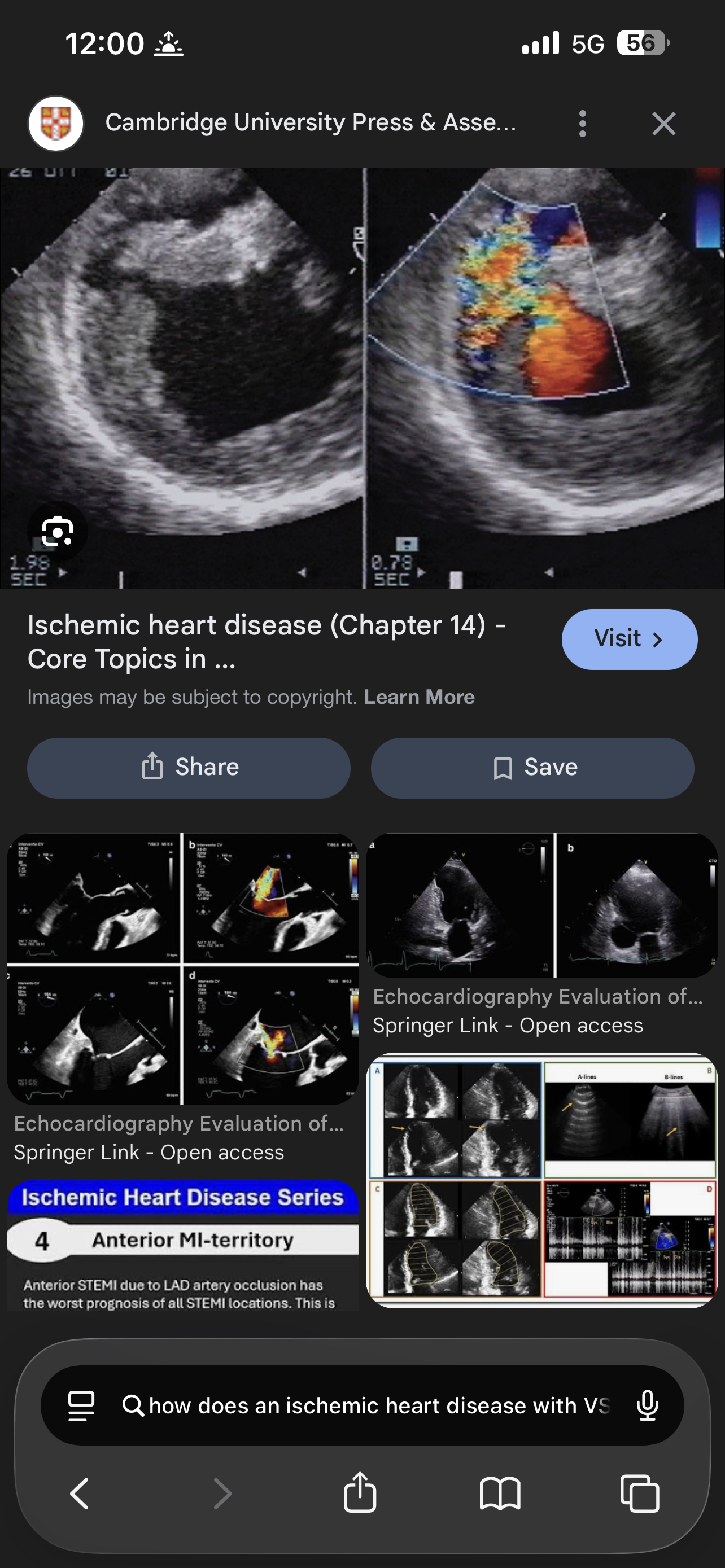 <p>What is Ischemic VSD caused by</p>