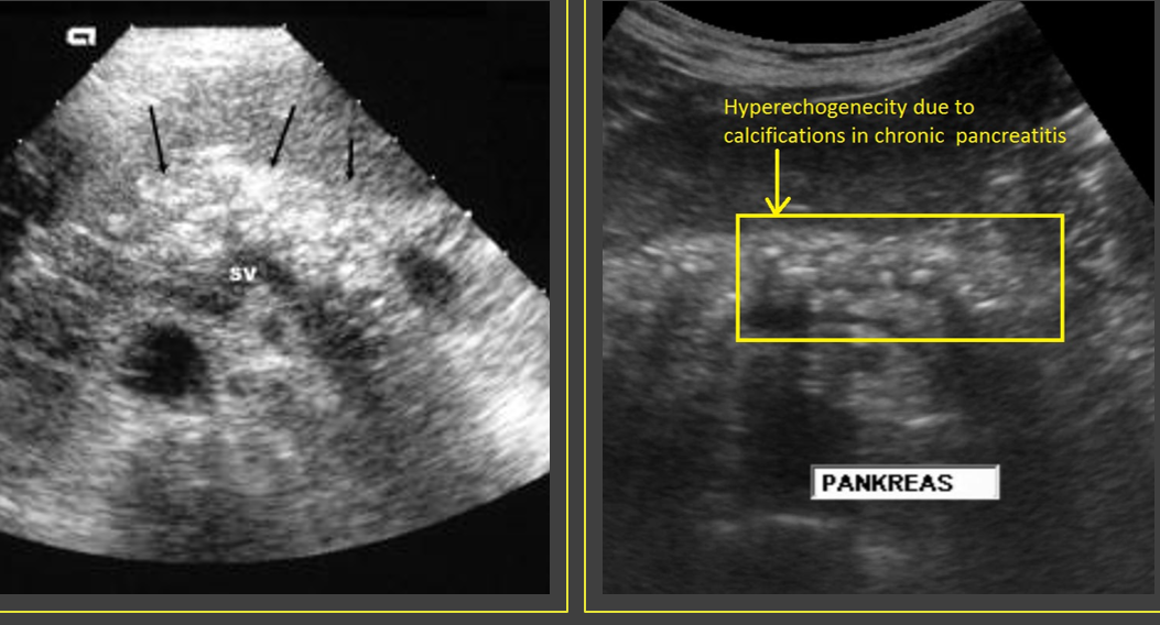 <p>Chronic ______ pancreatitis has fibrous _____ tissue that rapidly grows around the ____ and between _____ that results in ______. This leads to a _______, _____ surface of the pancreas</p>