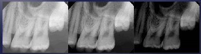 <p>radiographic density (how dark image is)</p>