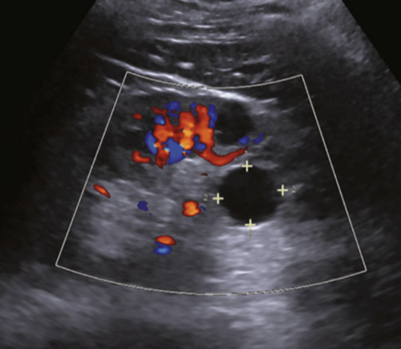 <p>Which cyst is NOT located in the renal hilum? Where is it located?</p>
