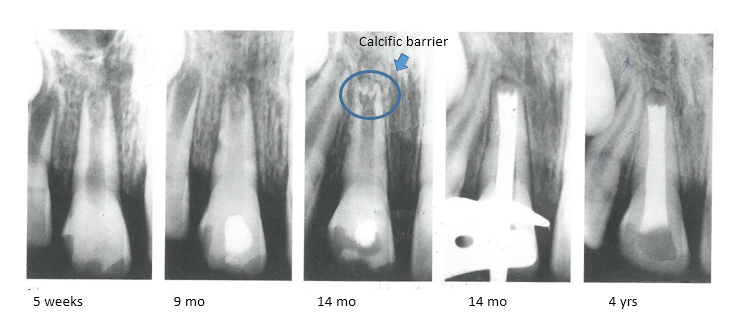<p>What are these series of radiographs showing?</p>
