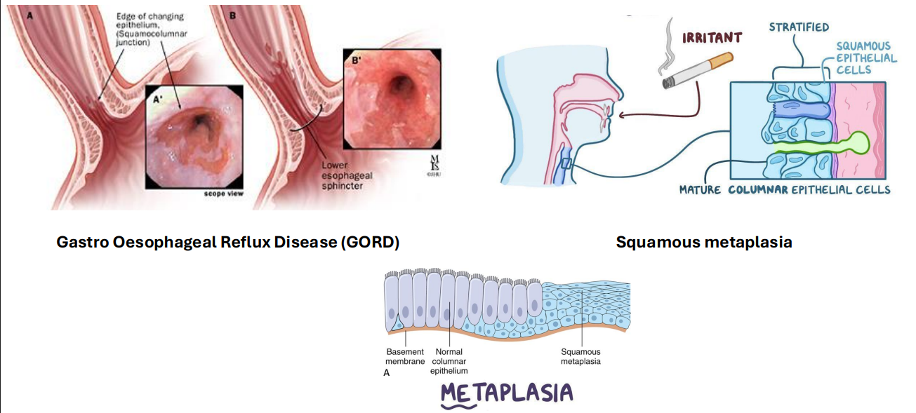 <p>Metaplasia Examples</p>