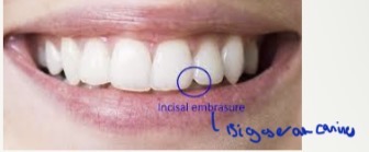 <p>Open space formed between proximal surfaces of incisal edges from contact points </p><p>Increase in depth from central to canine</p>
