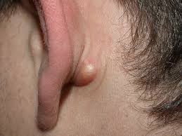 <p>aka: sebaceous cyst</p><p>forms at 9-o’clock on posterior ear</p><p>closed firm sac attached to the epidermidis</p>