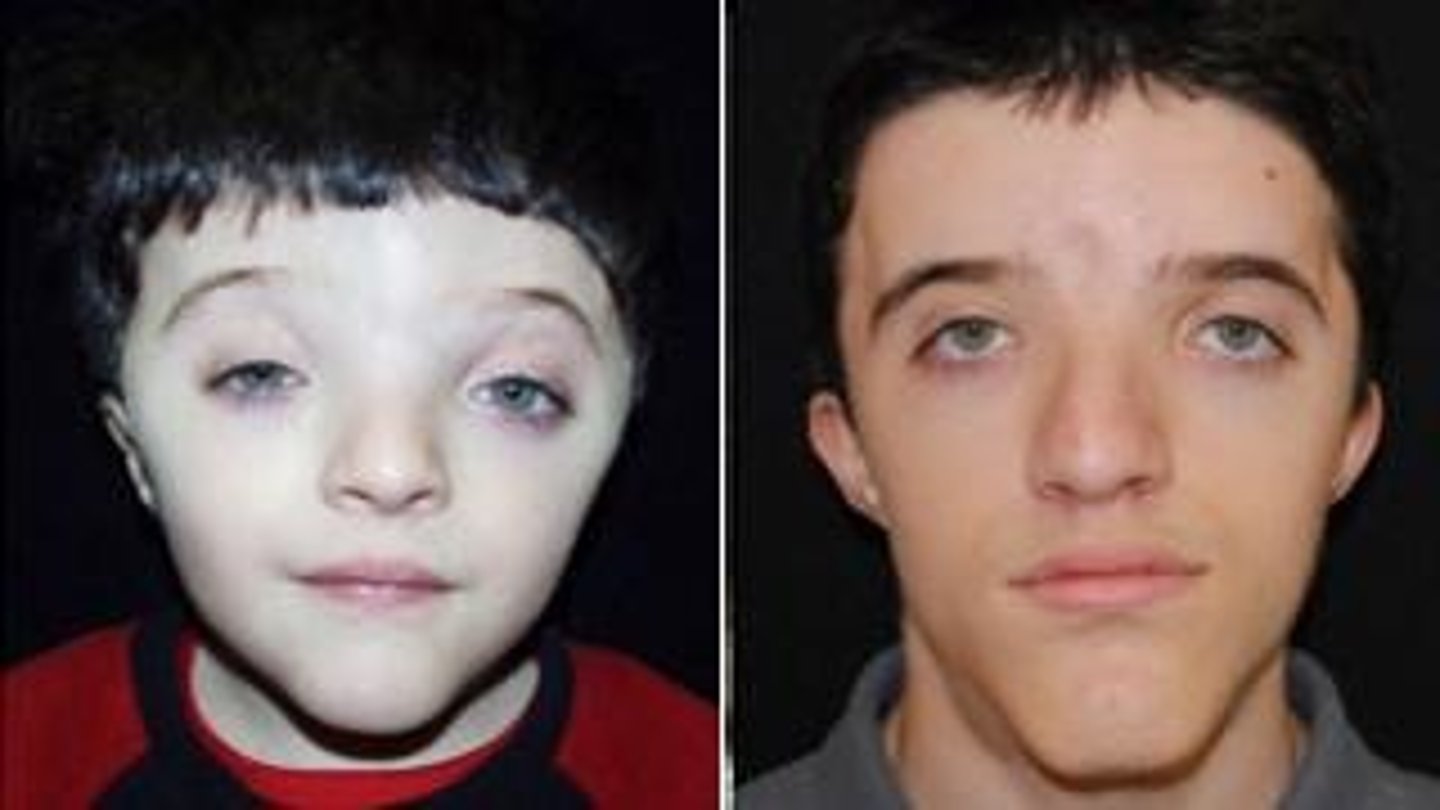 <p>•Abnormally shaped head</p><p>•Low frontal hairline</p><p>•Ptosis</p><p>•Wide spaced eyes</p><p>•Broad nasal bridge</p><p>•Facial asymmetry</p><p>•Small ears</p><p>•Fusion of 2nd and 3rd fingers</p><p>•Usually normal intelligence</p>