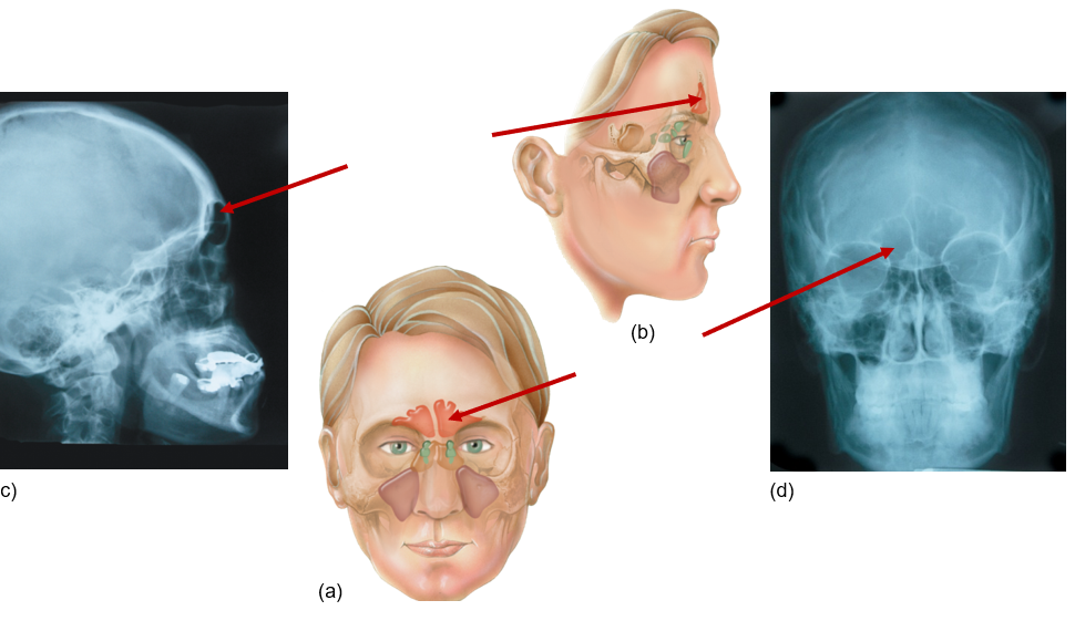 <p>Front of head, above eyes</p>