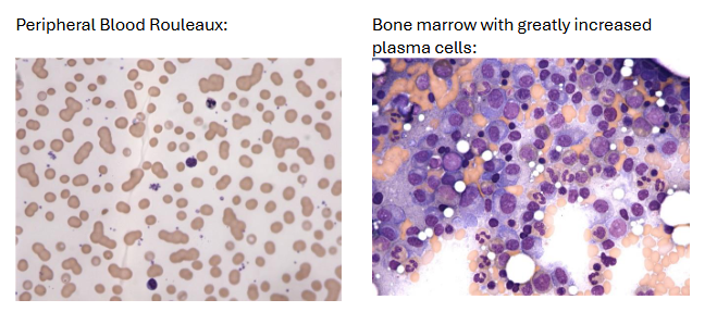 <ul><li><p><span>Monoclonal gammopathy – Incidence: IgG>IgA>IgM>IgD>IgE</span></p></li><li><p><u><span>Generalized hypogammaglobulinemia with Bence Jones proteinuria</span></u></p></li><li><p><span>Peripheral blood: </span><u><span>Rouleaux</span></u><span>, increased ESR</span></p></li><li><p><span>Bone marrow: Varying number of mature and immature </span><strong><span>plasma cells</span></strong></p><ul><li><p><span>Cells are frequently enlarged with less chromatin clumping than seen in benign plasma cells</span></p></li><li><p><span>Multinucleated cells seen</span></p></li></ul></li></ul><p></p>