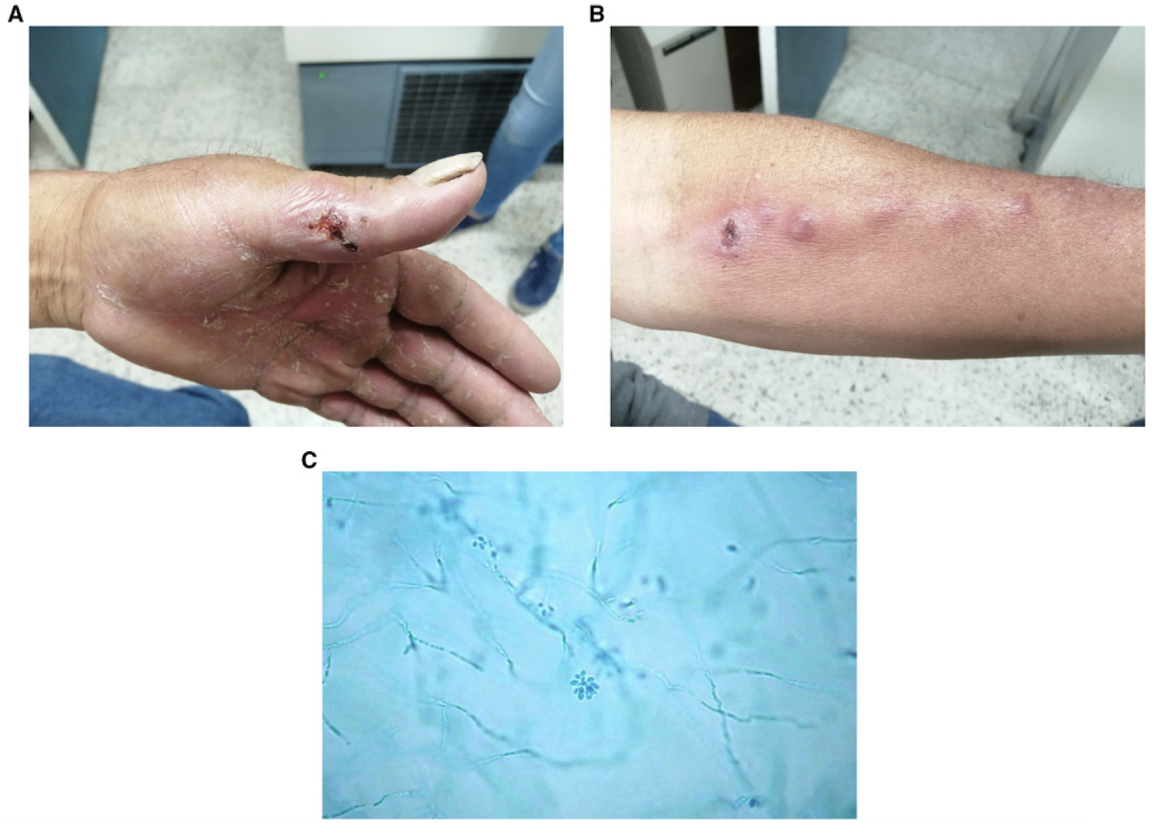 <p>Which fungus is transmitted by traumatic <strong>lacerations/puncture wounds</strong> from <strong>contaminated soil/decaying vegetation</strong> and causes <strong>sporotrichosis and erythema nodosum?</strong></p><ul><li><p>rose gardener’s disease: occupational hazard</p></li><li><p>infects epidermis, can spread along lymphatic system to subcutaneous tissue and bone or CNS</p></li><li><p>no person-to-person transmission</p></li></ul>