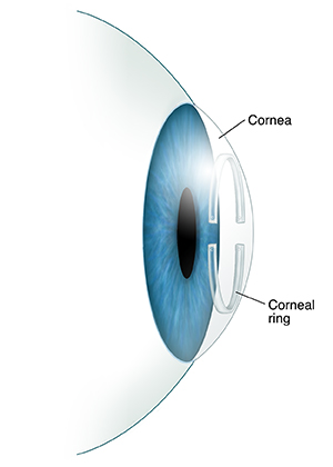 <ul><li><p>Transparent, dome-like structure on the front part of the eye</p></li><li><p>Gives eye focusing or refracting power</p></li></ul>