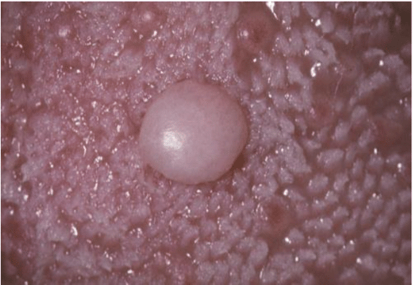<p>• Fibrous tumor</p><p>• Unlike the traumatic fibroma, it</p><p>does not appear to be</p><p>associated with chronic irritation</p>