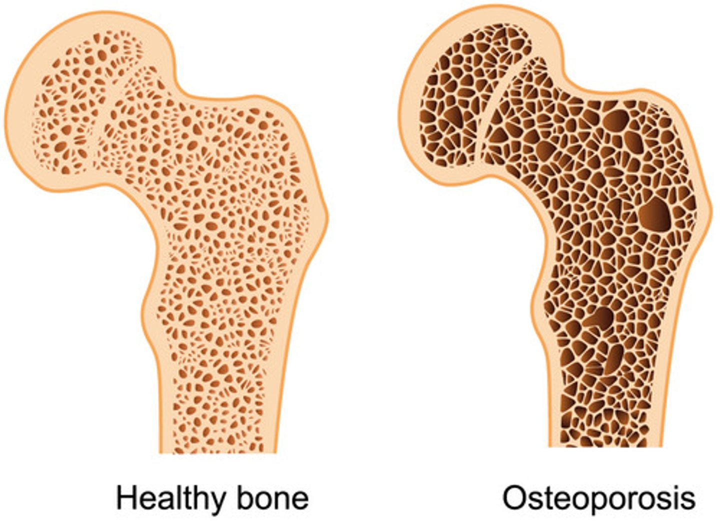 <p>loss of bone density caused by excessive absorption of calcium from bone</p>