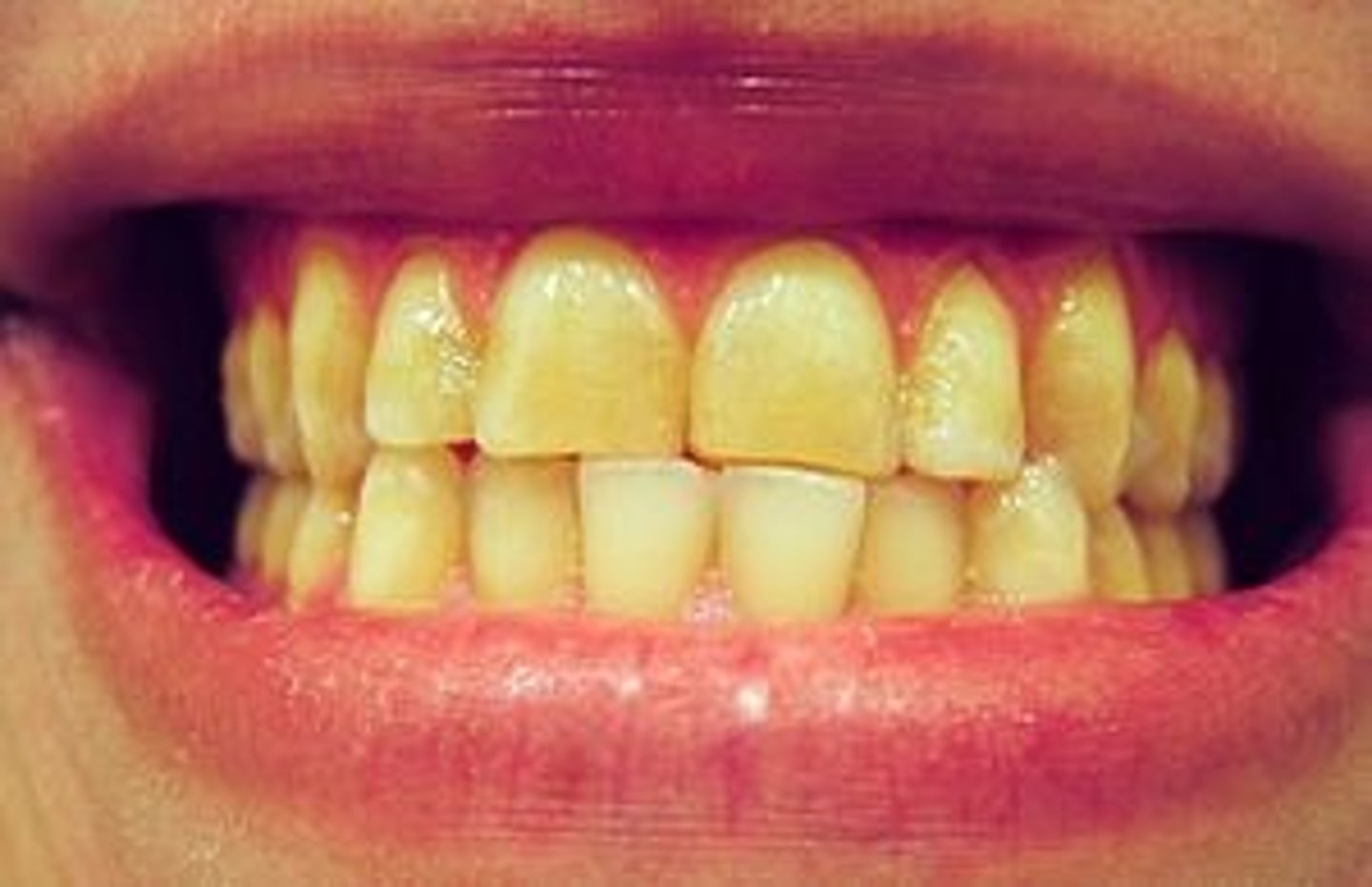 <p>BRUXISM</p>