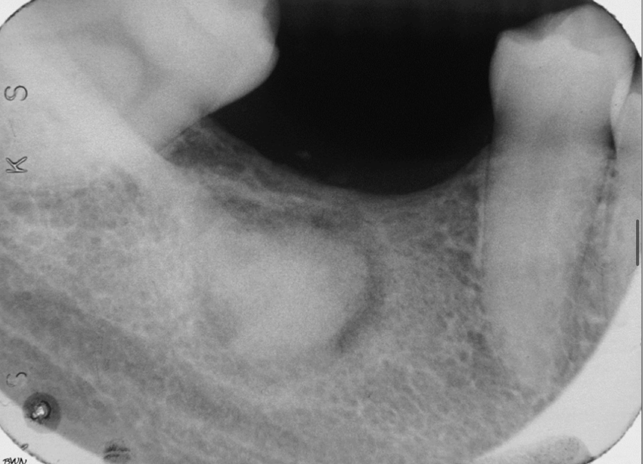 <p>Radiolucent rim </p>