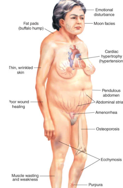 <p><strong>surgery</strong>: pituitary adenoma removal (transsphenoidal surgery) </p><p><strong>radiation </strong>or <strong>pharmacologic treatments </strong>based on the cause </p><p><strong>goal: </strong>correct the cause of hypercortisolism without damaging pituitary or adrenal glands </p>