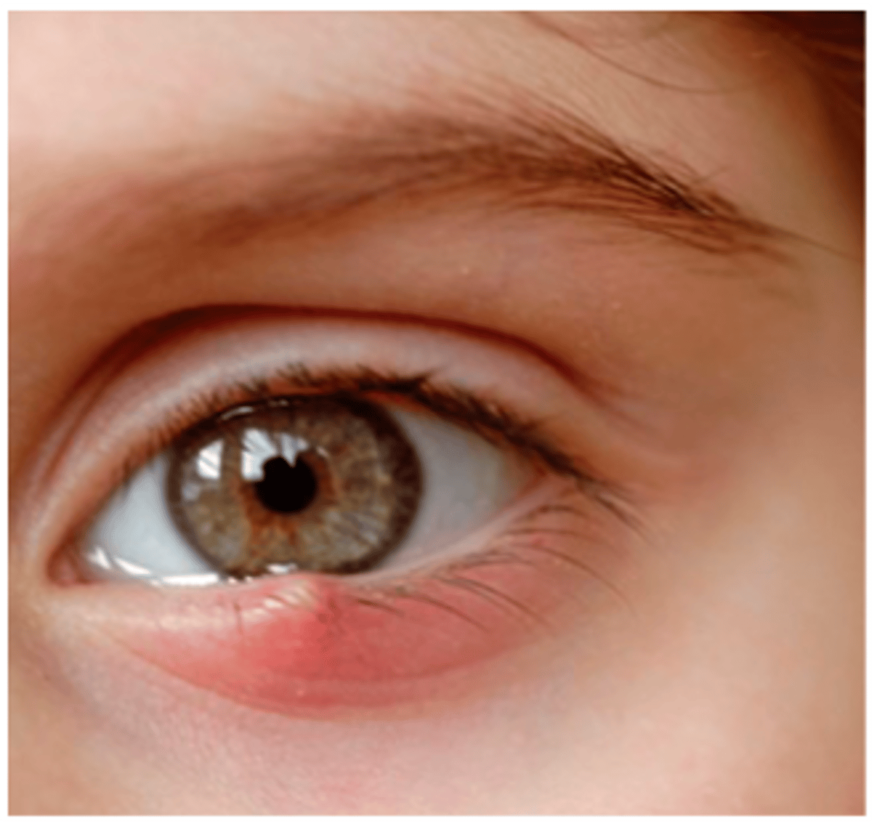 <p>name the eyelid abnormality</p>