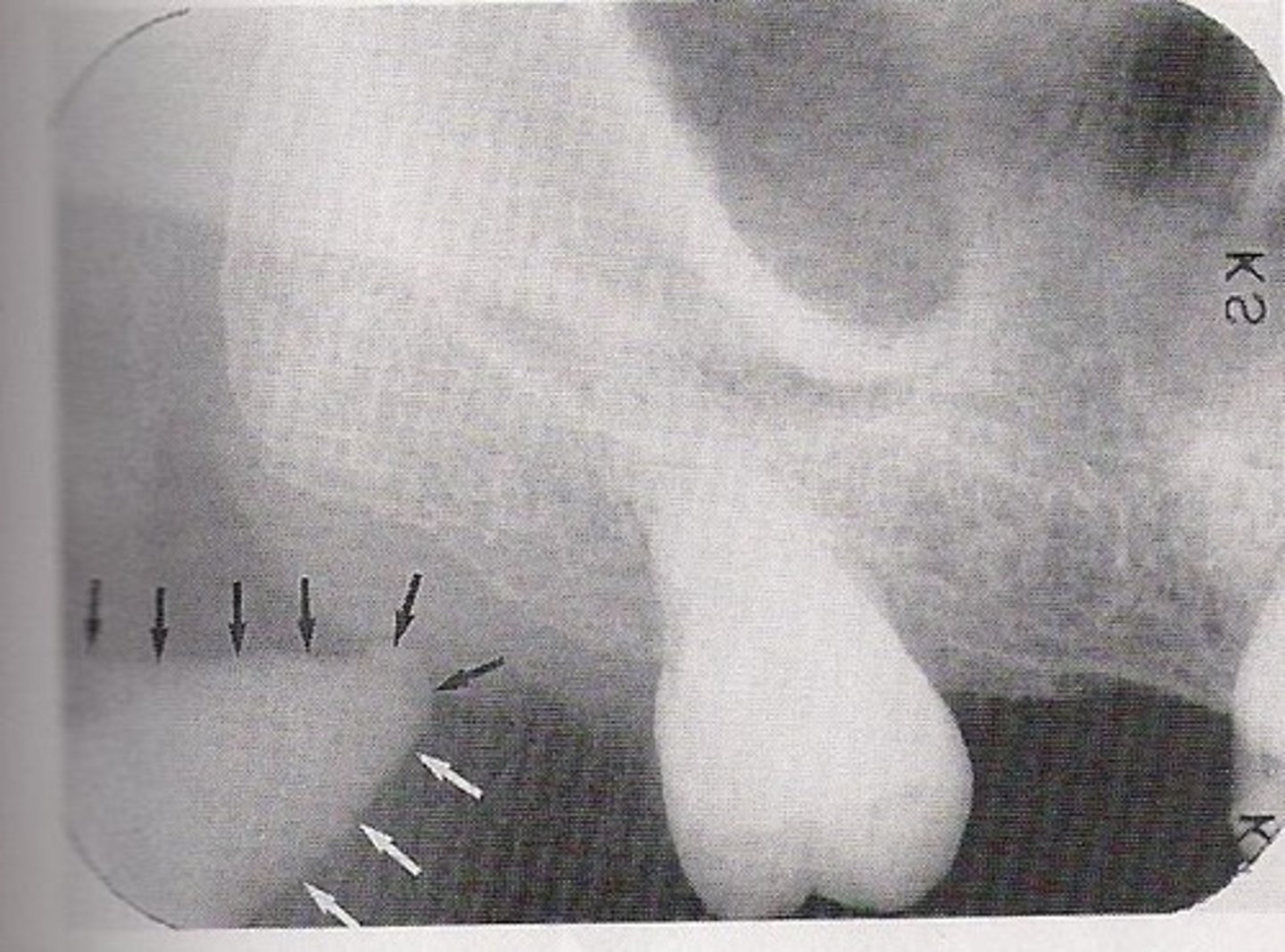 <p>Point of muscle attachment</p>