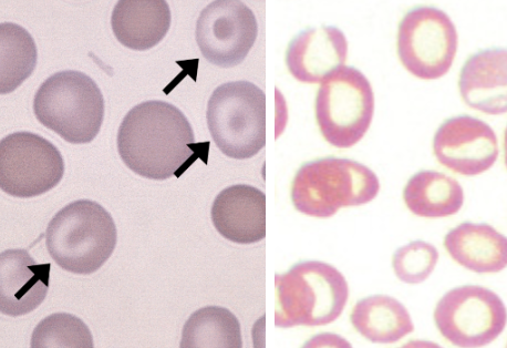 <p>what disease/condition is associated with increased codocytes and hypochromia?</p>
