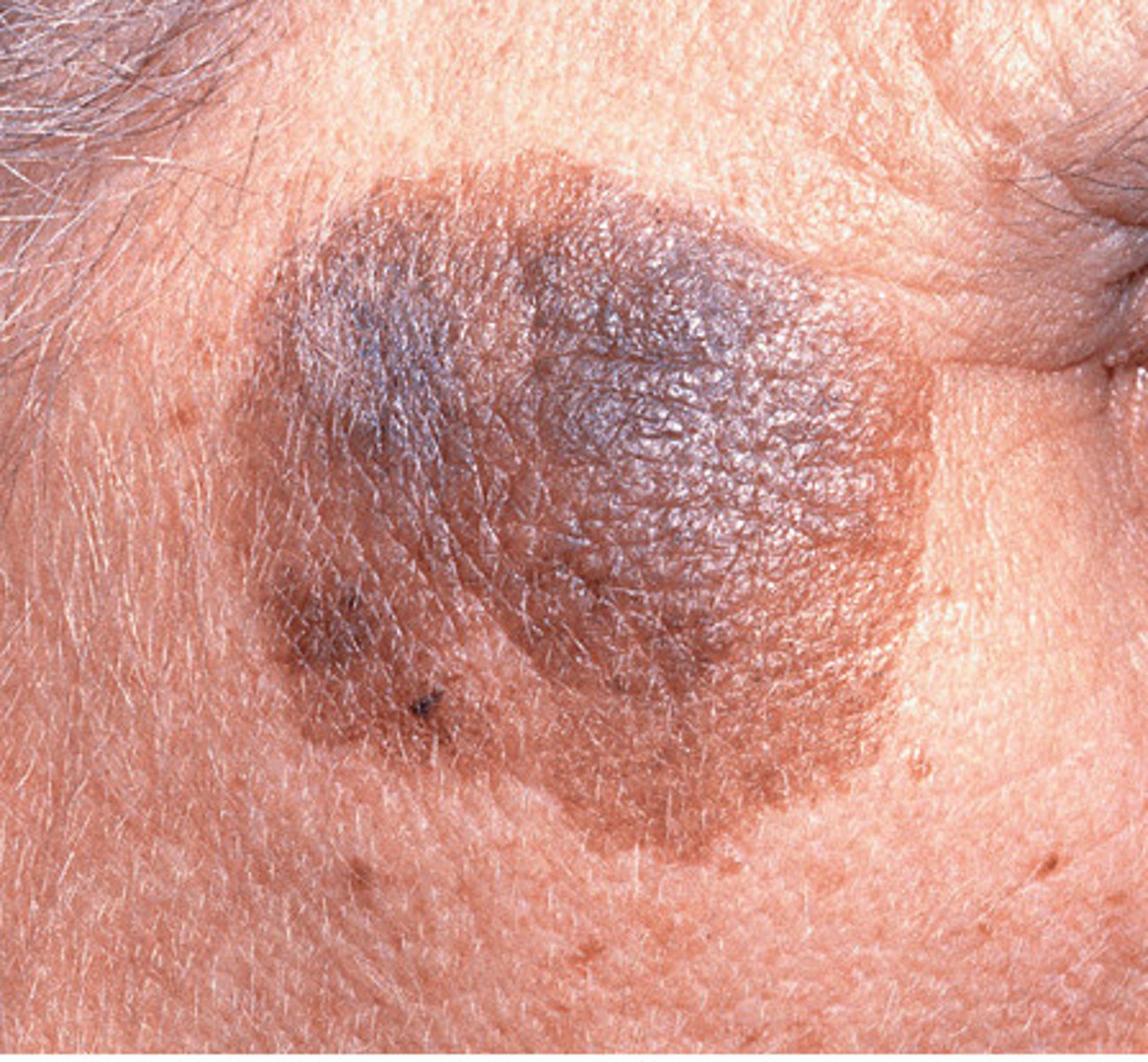<p>-subtype of melanoma in situ</p><p>-enters a vertical growth phase and invades the dermis</p><p>-RF: UV exposure, usually seen in older people</p>