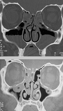 <p>What pathology is pictured here?</p>