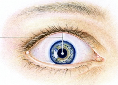 <p>= when the white rim of the sclera is seen between the iris and upper eyelid</p><ul><li><p>occurs with hyperthyroidism.</p></li></ul>