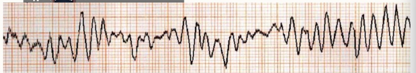 <ol><li><p>irregular deformed wave</p><ul><li><p>no distinct P wave, QRS complex or T wave anywhere</p></li></ul></li><li><p>ventricular myocardium depolarising erratically (not one smooth motion)</p><ul><li><p>re-entry, triggered activity, automaticity</p></li></ul></li></ol><p></p>