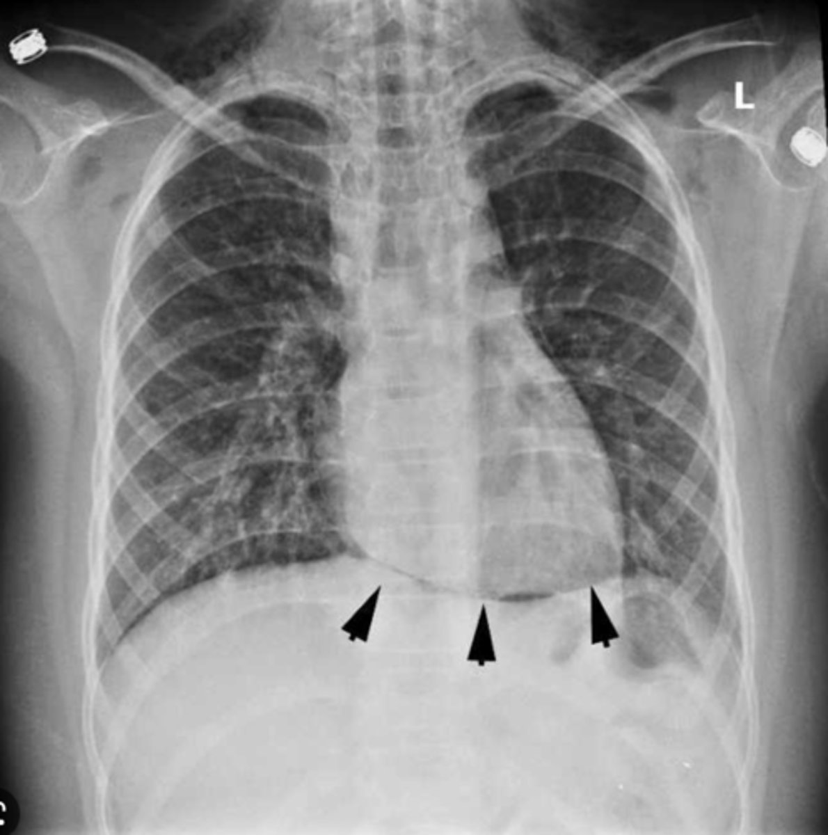 <p>horizontal, formed mainly by right ventricle (on x-ray)</p>