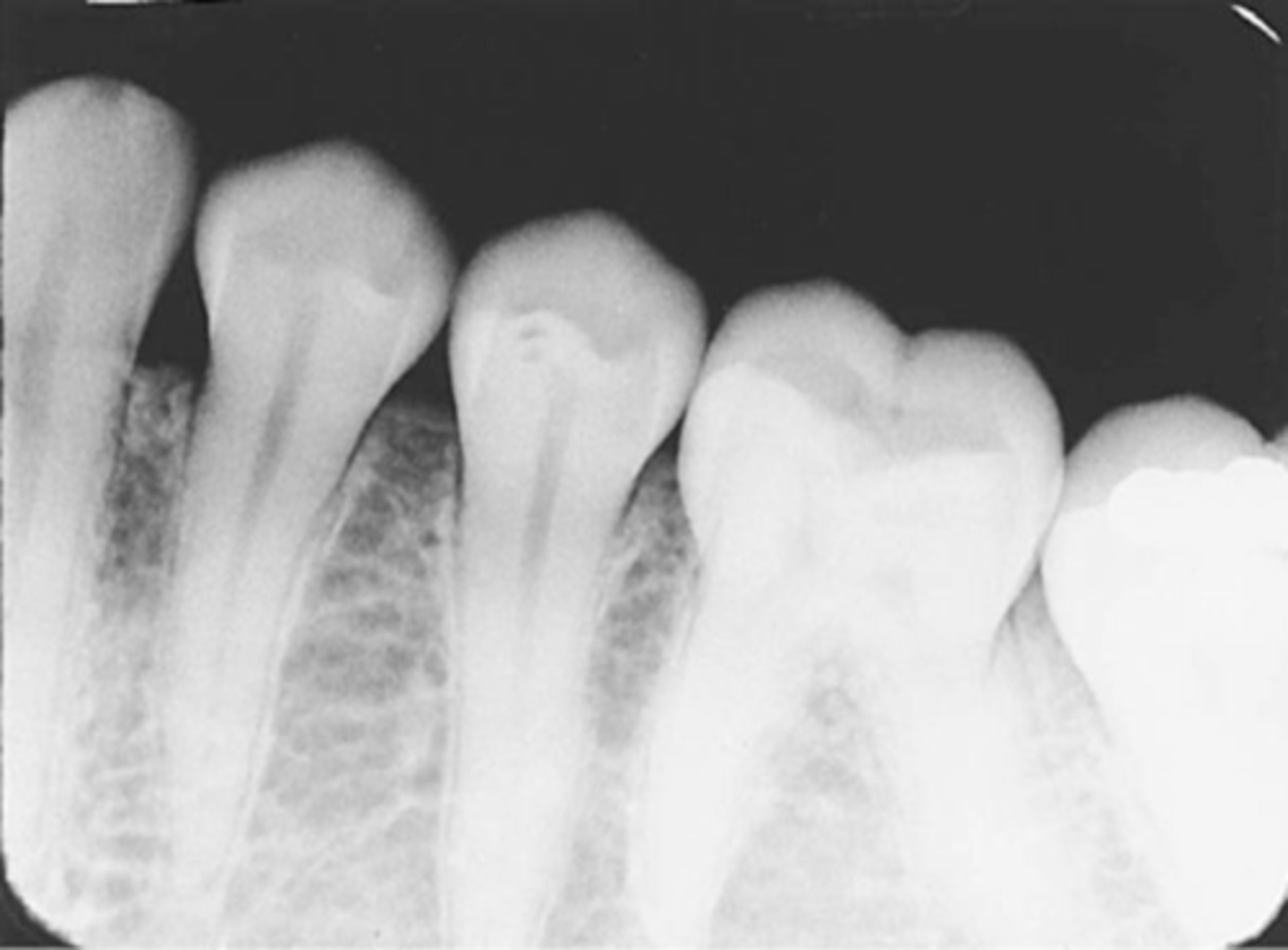 <p>-Occlusal plane appears tipped or tilted</p><p>-Edge of receptor was not placed parallel to the incisal/occlusal surfaces of teeth, resulting in the occlusal plane appearing tipped on the radiograph.</p><p>-If pt. is not instructed to close on the bite block to hold the receptor firmly against the tooth, a corner of the receptor may drop or slip.</p><p>-To prevent this make certain that the edge of the receptor is placed parallel to the incisal/occlusal surfaces as the pt. bites their teeth together.</p>