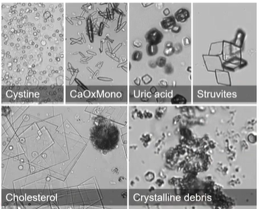 <p>Calcium oxalate monohydrate</p><p>Cystine</p><p>Cholesterol</p><p>Uric acid</p><p>Drug-related</p><p>Atypical presentations of reported crystal types</p>
