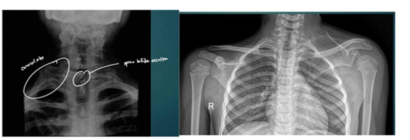 <p>If we see more than two abnormalities, what anomaly are we looking at?</p>