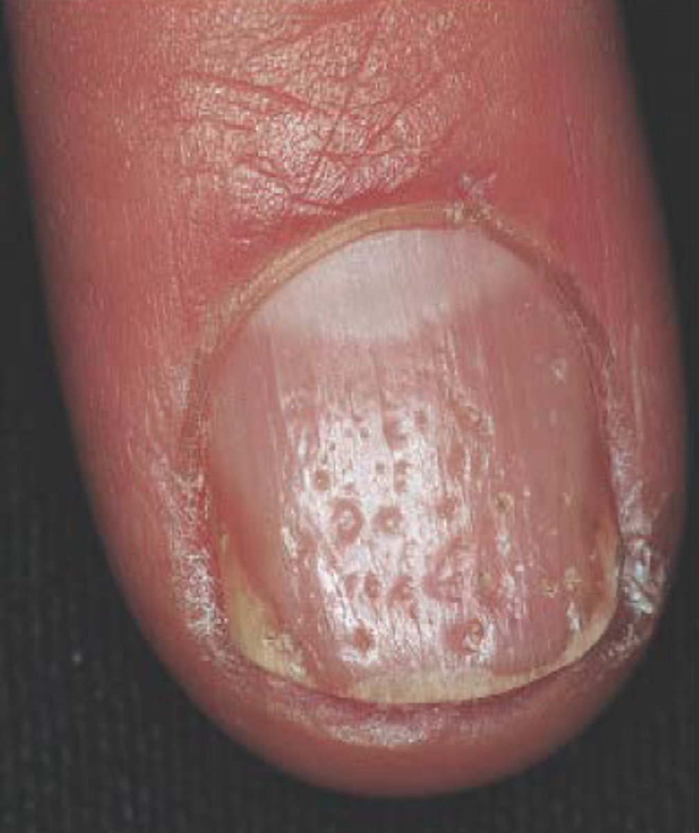 <p>small depressions in the nails are common in people with psoriasis, may cause the nails to crumble</p>