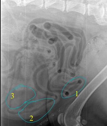 <ul><li><p><strong><u>cannot be accurately done on x-rays</u></strong></p><ul><li><p>combo of fluid and gas filled</p></li></ul></li><li><p>diameter is <strong><u>&lt; height of a lumbar vertebral body</u></strong></p><ul><li><p>should be <strong>uniform</strong></p></li></ul></li><li><p><strong>Gas distended bowel </strong></p><ul><li><p>wall looks <strong>thin</strong> and <strong>smooth</strong></p></li></ul></li><li><p><strong>Partially fluid filled </strong></p><ul><li><p>gas floats to top</p></li><li><p>wall <strong>falsely </strong>looks <strong>thick</strong></p></li></ul></li><li><p><strong>Completely fluid filled </strong></p><ul><li><p>Fluid <strong>silhouettes</strong> </p></li><li><p><strong>can’t see the inner</strong> margins of it at all</p></li></ul></li></ul><p></p>