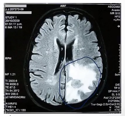 <p>-blood brain barrier</p><p>-trauma or stroke</p><p>-swelling</p>