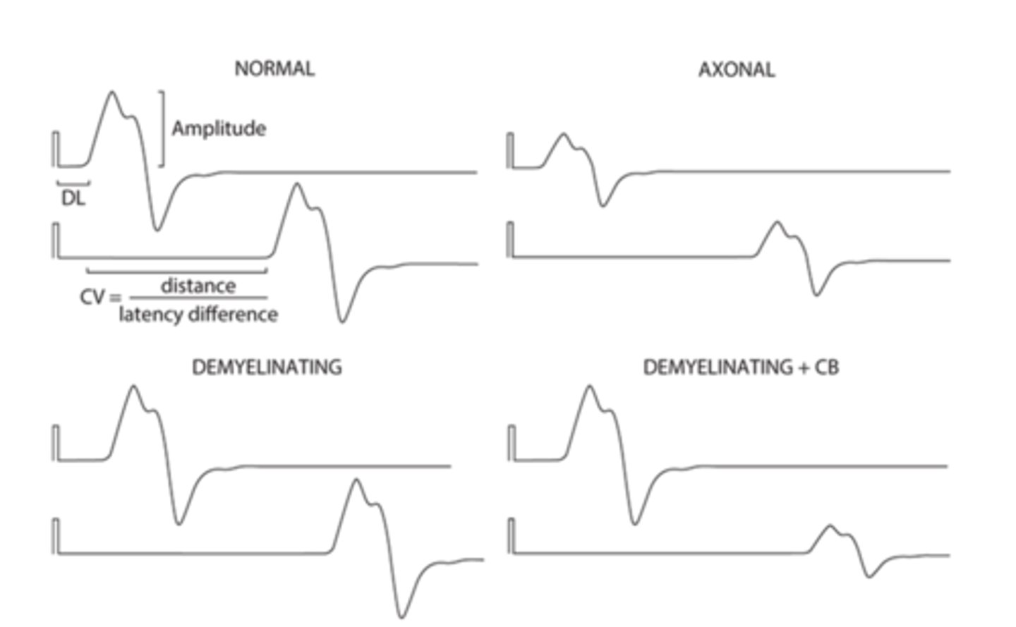 <p>Neuropathies e.g. carpal tunnel syndrome</p>