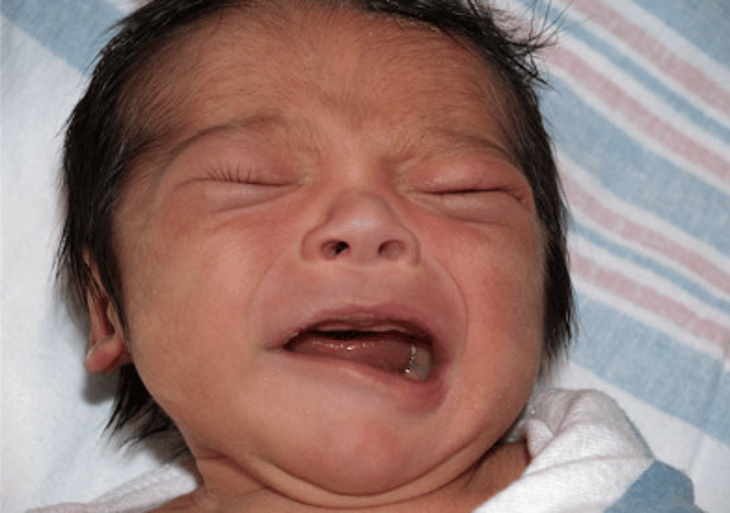 <p>- pressure against maternal sacrum</p><p>- forceps injury?</p><p>- most prevalent during crying</p><p>- usualy resolves</p>