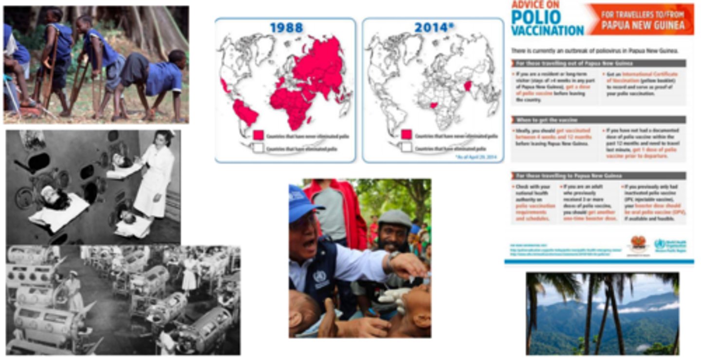 <p>polio</p>