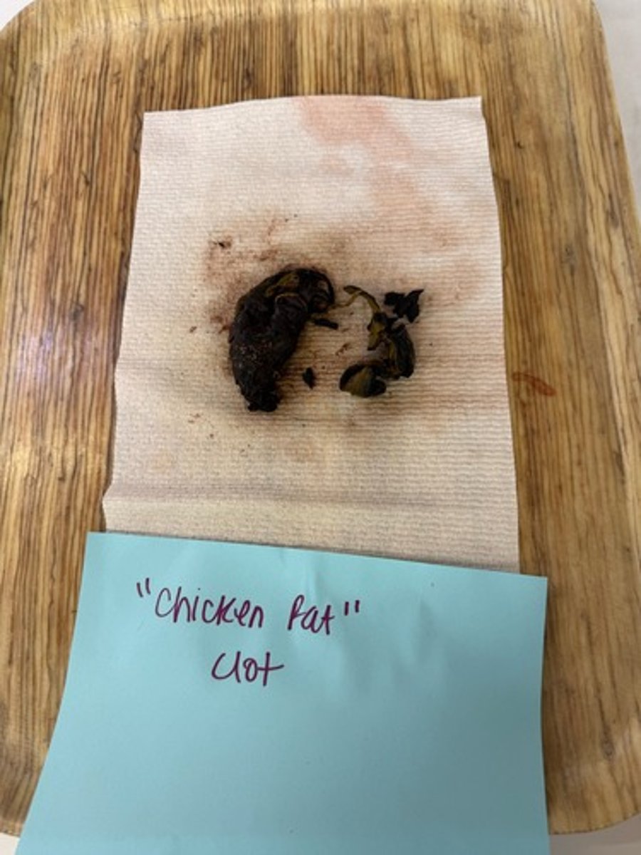 <p>What is this lesion?</p>