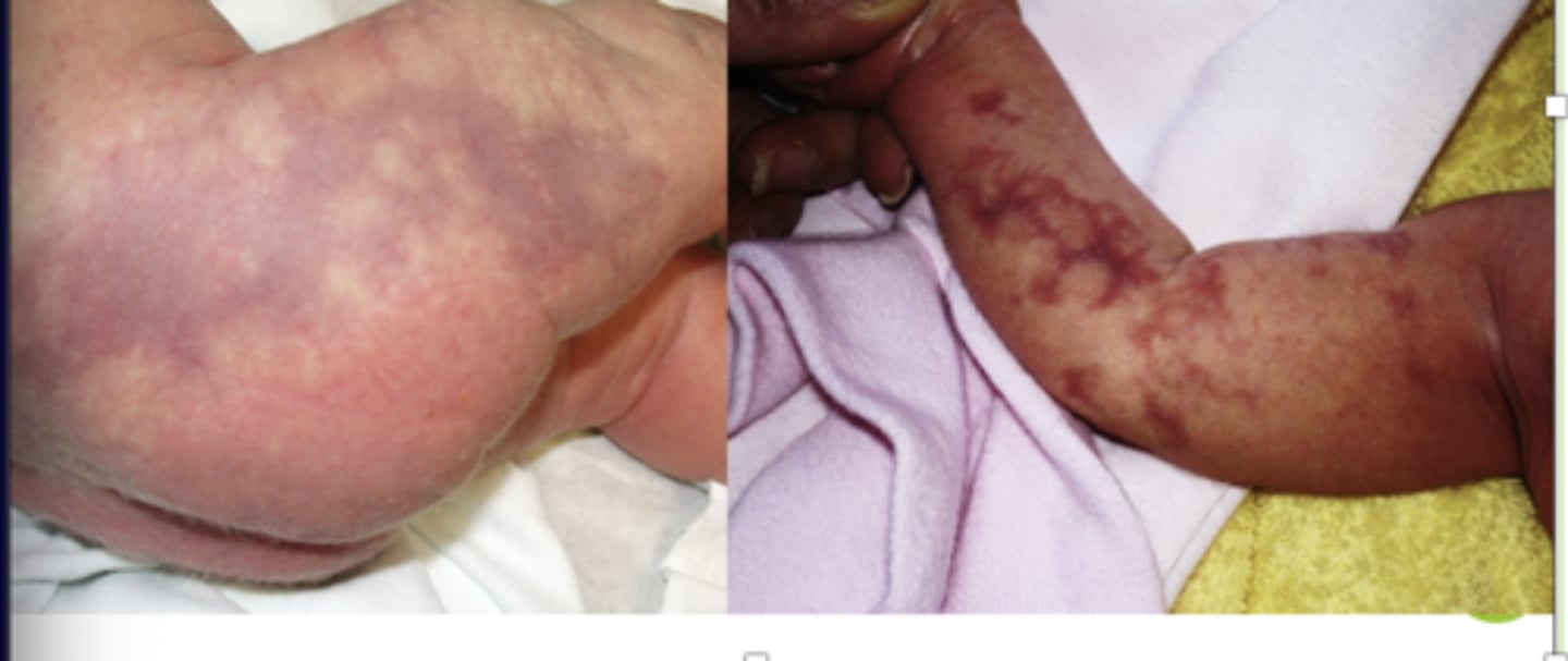 <p>- type of vascular malformation</p><p>- deep purple, marble or net like</p><p>- does NOT fluctuate with temperature changes</p>