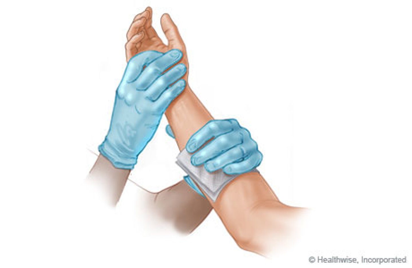 <p>With clean dressing, put gauze pads on the cut.- elevate arm.</p><p>Hold for 1 minute and state that you are holding for 1 minute.</p><p>If bleeding continues, place more clean gauze pads and hold 1 more minute with more pressure. Bleeding should subside. Judge will sat bleeding stopped.</p><p>Wrap arm with some kind of bandage to maintain pressure. Do a pressure wrap" Treat for shock</p>
