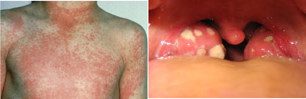 <p>fever &gt; 38C; tender anterior cervical adenopathy; lack of cough; pharyngotonsillar exudate; along with sandpaper-like rash</p>