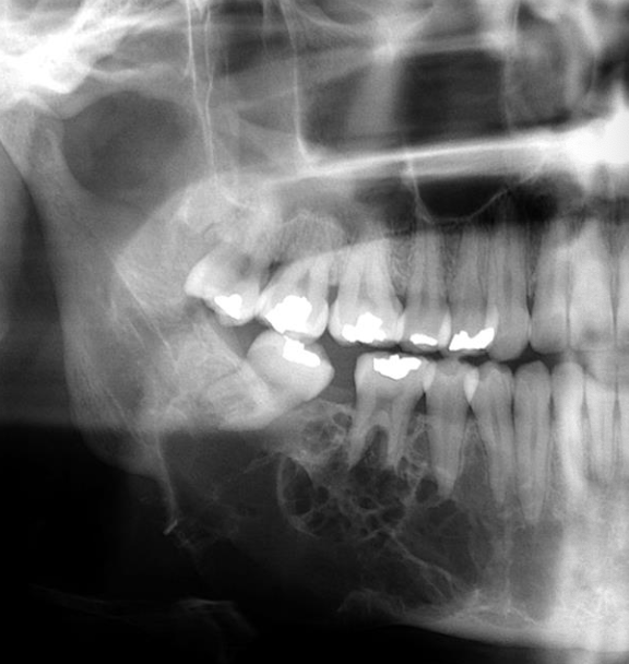 <p>Not encapsulated, tend to infiltrate the surrounding cancellous bone —&gt; high recurrence</p>