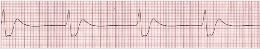<p>regular, HR 20-40, wide QRS, no P waves</p>