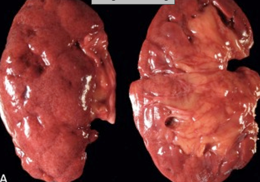 <p>What pathology is shown here?</p>