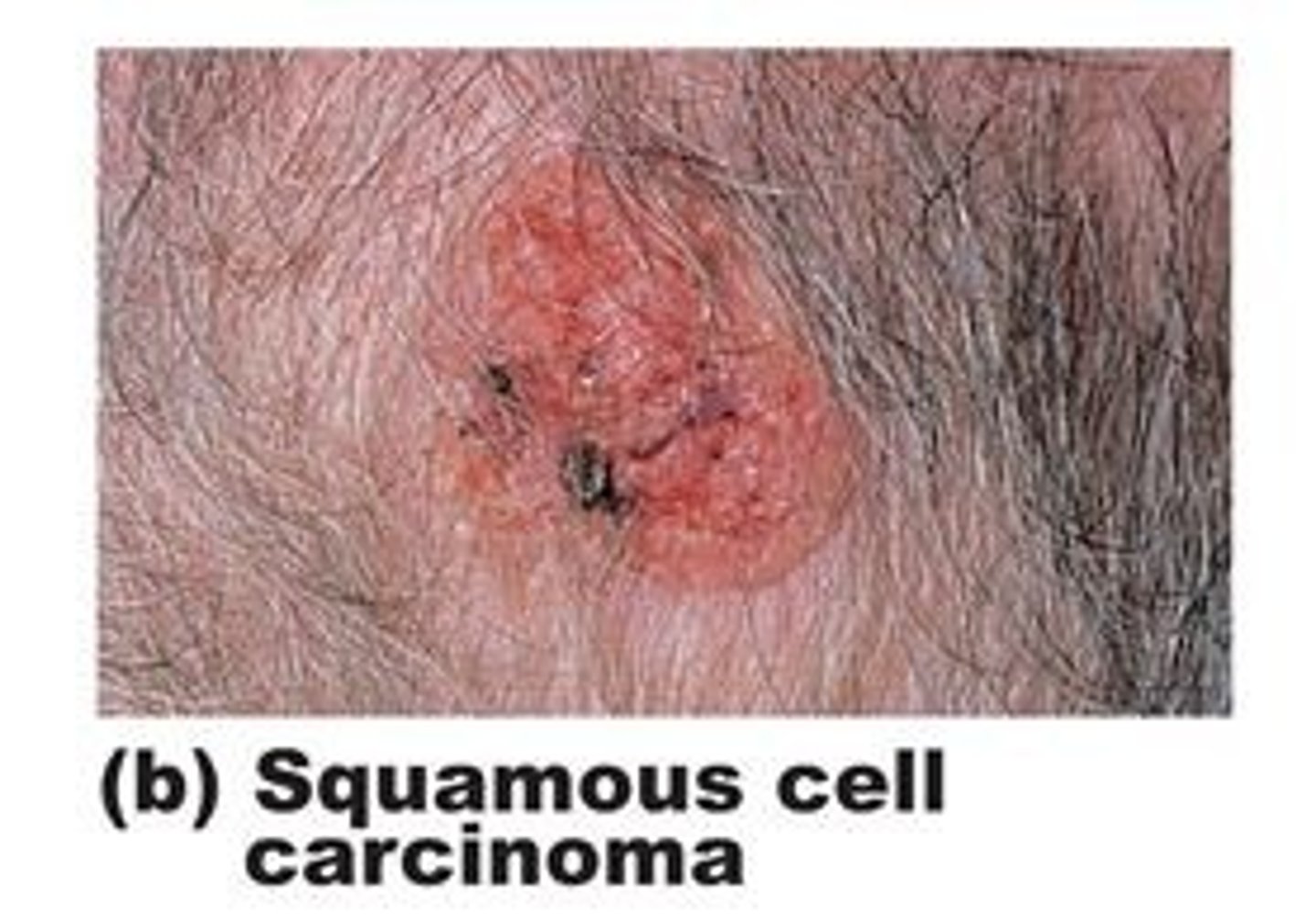 <p>second most common, arises form keratinocyte's if the stratum spinosum, scaly reddened papule, head scalp ears lip and hands, grows fast will metastasize if not treated by surgery or radiation</p>